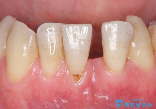 歯肉移植　矯正前の歯肉退縮の改善および予防の治療前
