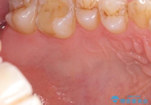 歯肉移植 矯正前の歯肉退縮の改善および予防の治療前