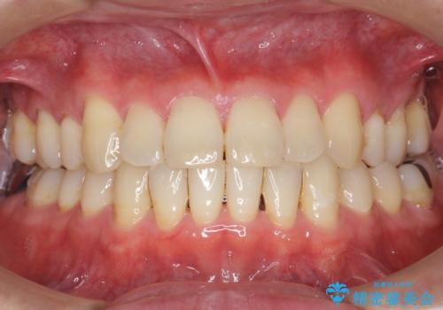 奥歯に違和感がある 30代男性の治療前