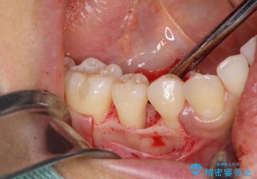このままでは抜歯と言われた 失われた骨の再生治療 の治療中