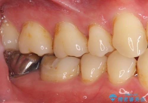 奥歯に違和感がある 30代男性の治療前