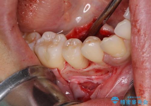 このままでは抜歯と言われた 失われた骨の再生治療 の治療後