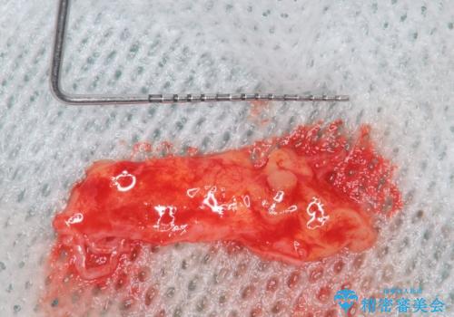 歯肉移植 矯正前の歯肉退縮の改善および予防の治療中