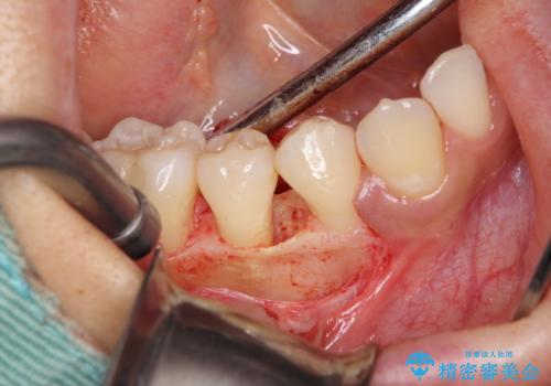 このままでは抜歯と言われた　失われた骨の再生治療　の治療前