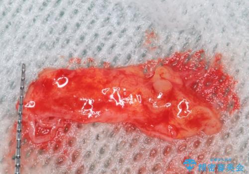 歯肉移植 矯正前の歯肉退縮の改善および予防の治療中