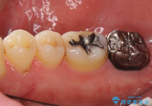 奥歯に違和感がある 30代男性の治療前