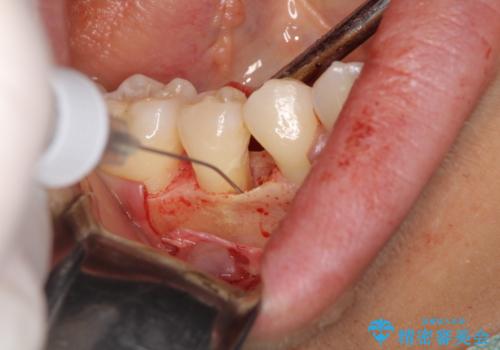 このままでは抜歯と言われた 失われた骨の再生治療