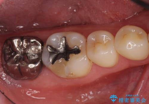 奥歯に違和感がある 30代男性の症例 治療前