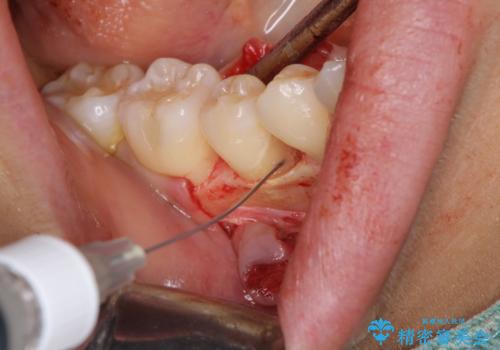 このままでは抜歯と言われた 失われた骨の再生治療 の治療後