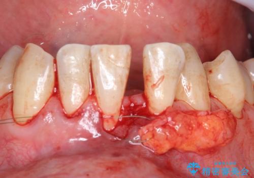 歯肉移植 矯正前の歯肉退縮の改善および予防の治療中