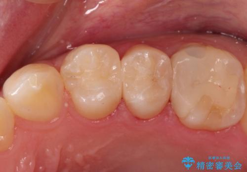 精密なむし歯の治療 セラミックインレーの治療後