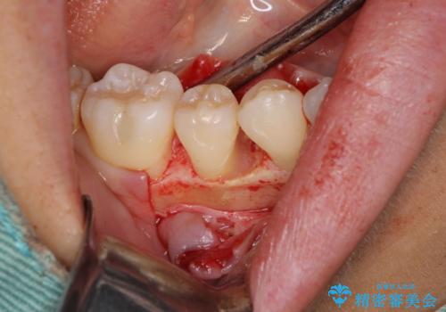 このままでは抜歯と言われた 失われた骨の再生治療 の治療中