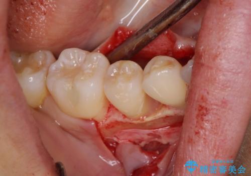 このままでは抜歯と言われた 失われた骨の再生治療 の治療後