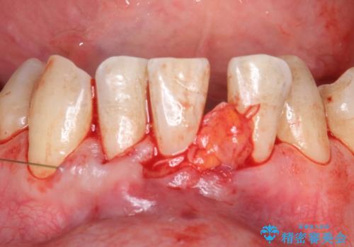 歯肉移植　矯正前の歯肉退縮の改善および予防の治療中