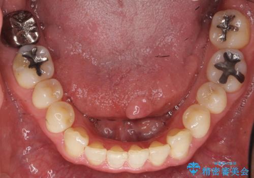 奥歯に違和感がある 30代男性の治療前