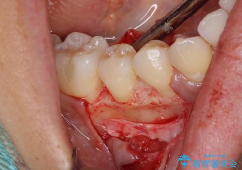 このままでは抜歯と言われた 失われた骨の再生治療 の治療後