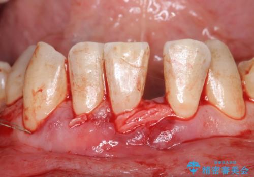 歯肉移植 矯正前の歯肉退縮の改善および予防の治療中