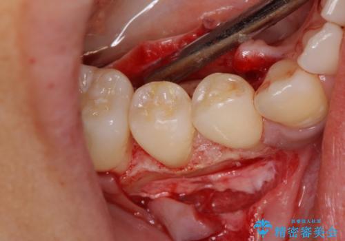 このままでは抜歯と言われた 失われた骨の再生治療 の治療中