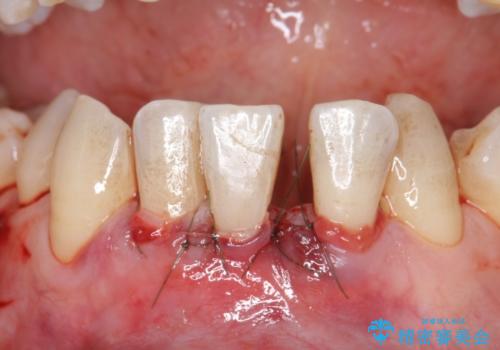 歯肉移植 矯正前の歯肉退縮の改善および予防の治療中