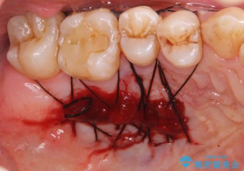 歯肉移植 矯正前の歯肉退縮の改善および予防の治療中