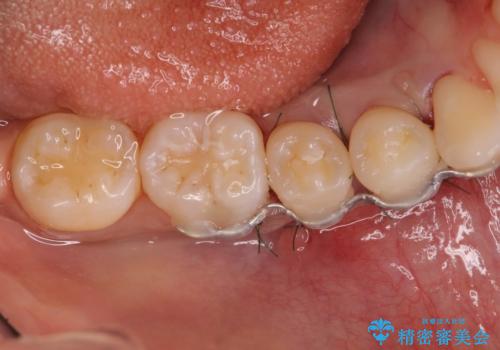 このままでは抜歯と言われた 失われた骨の再生治療 の治療中