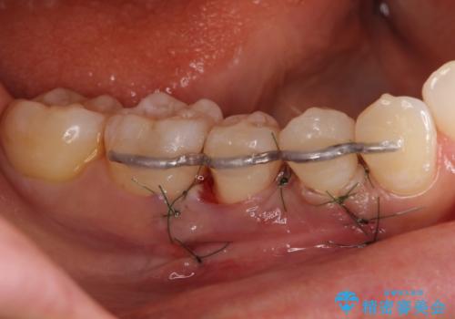 このままでは抜歯と言われた 失われた骨の再生治療 の治療中