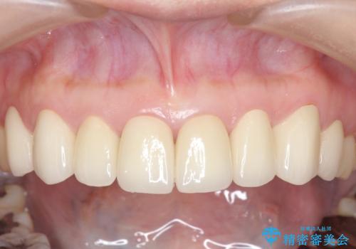 オールセラミッククラウン 前歯部の見た目の改善の治療後