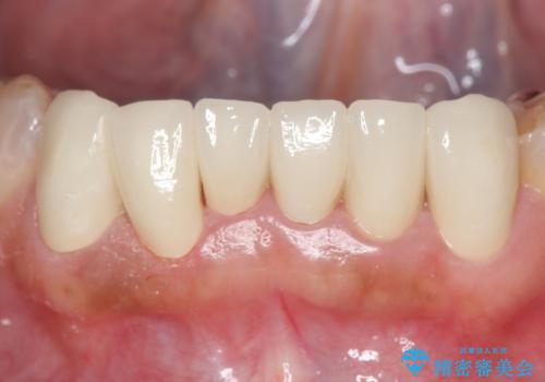オールセラミッククラウン 前歯部の見た目の改善の治療後