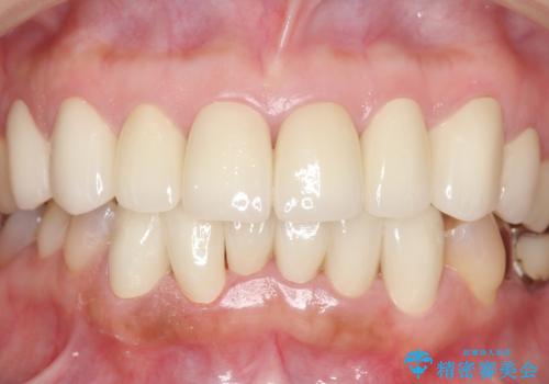 オールセラミッククラウン 前歯部の見た目の改善の治療後