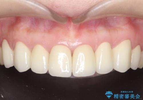オールセラミッククラウン 前歯部の見た目の改善の治療後