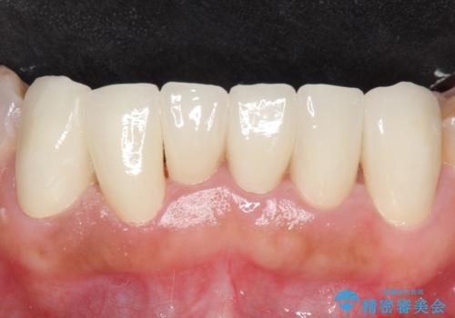 オールセラミッククラウン 前歯部の見た目の改善の治療後