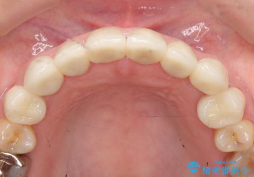 オールセラミッククラウン 前歯部の見た目の改善の治療後