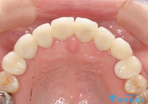 オールセラミッククラウン 前歯部の見た目の改善の治療後