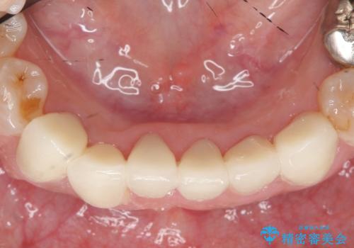 オールセラミッククラウン 前歯部の見た目の改善の治療後