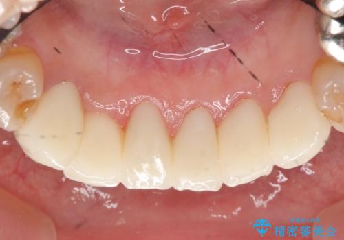 オールセラミッククラウン 前歯部の見た目の改善の治療後