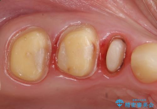 オールセラミッククラウン 根管治療 奥歯の補綴の治療中