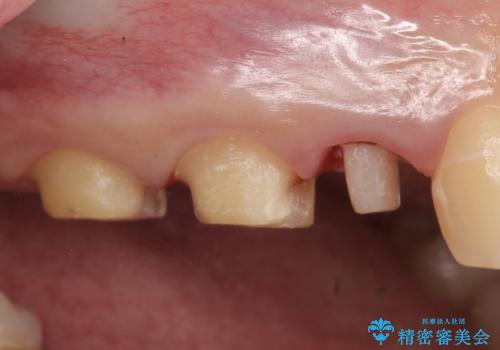 オールセラミッククラウン 根管治療 奥歯の補綴の治療中