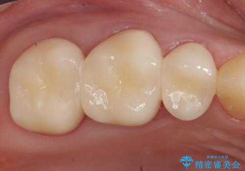 オールセラミッククラウン 根管治療 奥歯の補綴の症例 治療後