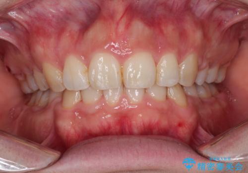 がたがたと出っ歯を直したい ワイヤーによる抜歯矯正の症例 治療後