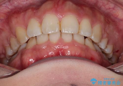 がたがたと出っ歯を直したい ワイヤーによる抜歯矯正の治療後