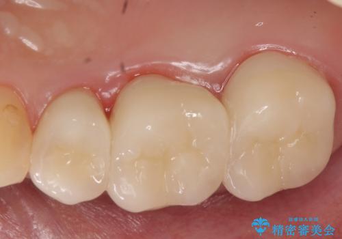 オールセラミッククラウン 根管治療 奥歯の補綴の治療後