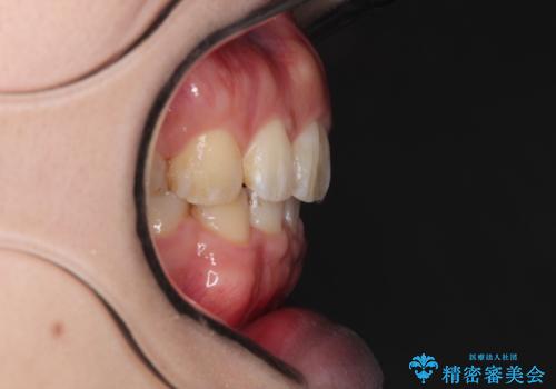 がたがたと出っ歯を直したい ワイヤーによる抜歯矯正の治療後