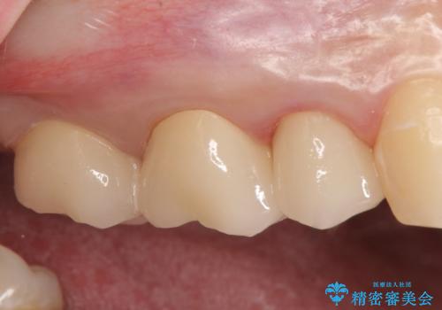 オールセラミッククラウン 根管治療 奥歯の補綴