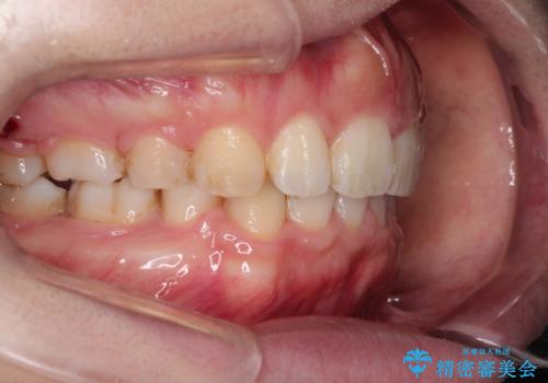 がたがたと出っ歯を直したい ワイヤーによる抜歯矯正の治療後