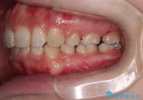 がたがたと出っ歯を直したい ワイヤーによる抜歯矯正の治療後