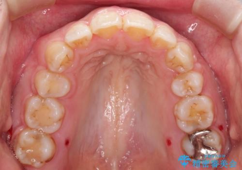 がたがたと出っ歯を直したい ワイヤーによる抜歯矯正の治療後