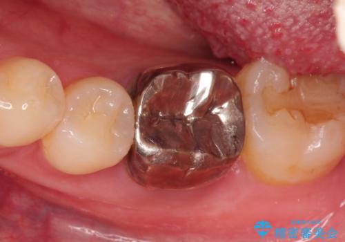 銀歯を白くしたい セラミッククラウンの治療前