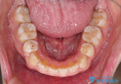 がたがたと出っ歯を直したい ワイヤーによる抜歯矯正の治療後