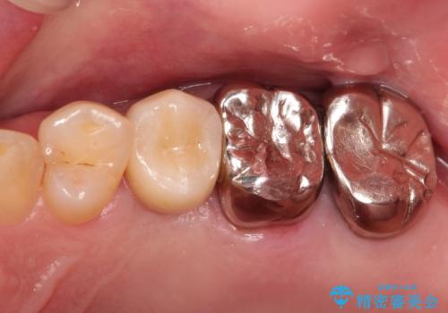 小臼歯部のインプラントの治療後