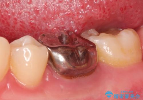 銀歯を白くしたい セラミッククラウンの治療前